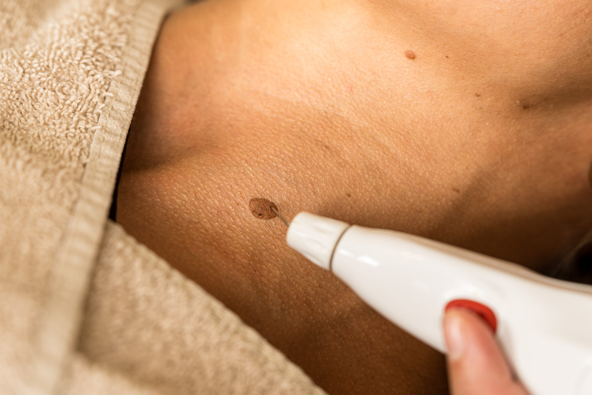 Huid & Laseer - huidverbetering - denekamp-67