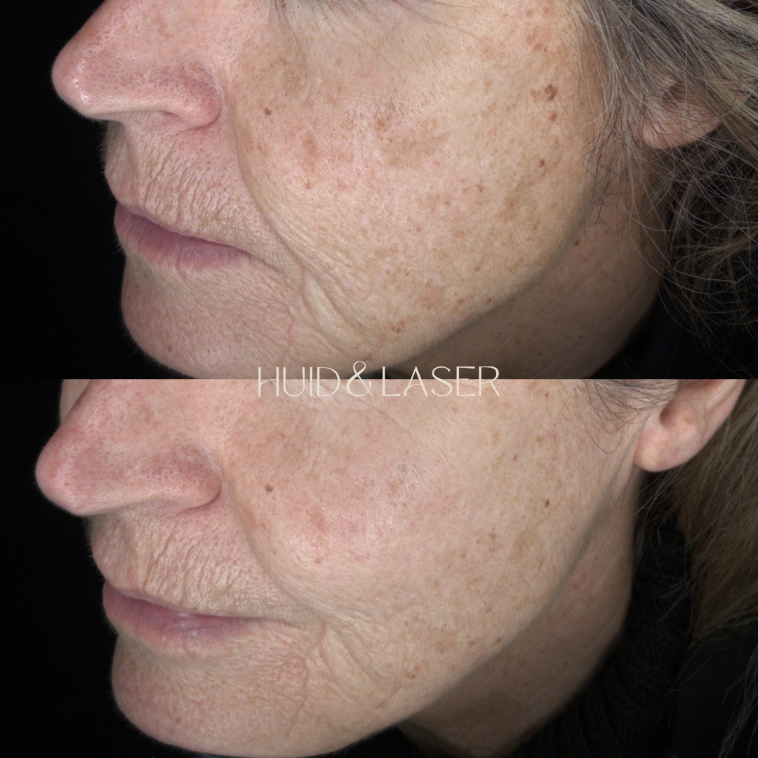Chemische peeling 1