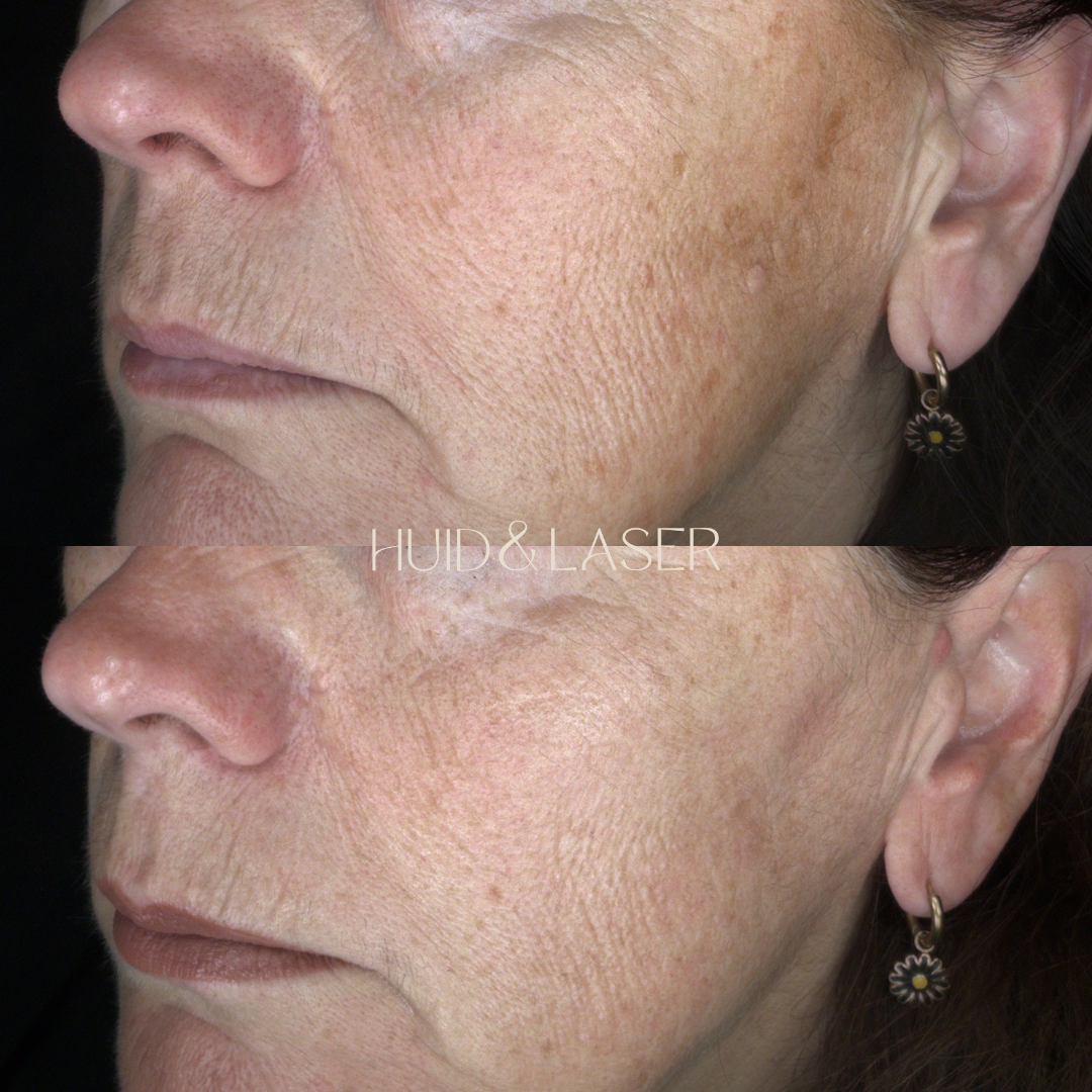 Chemische peeling 2