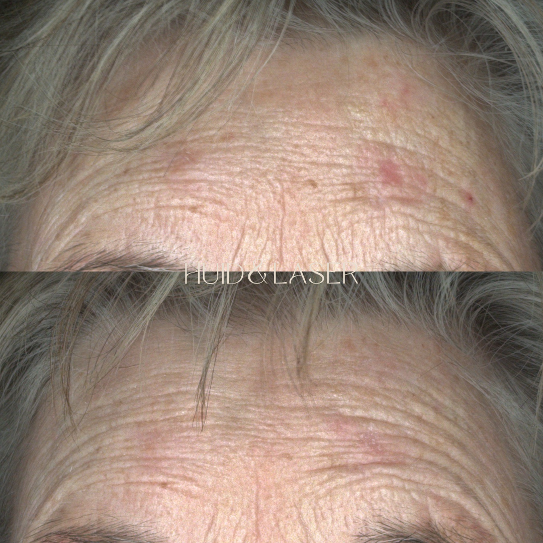 Chemische peeling 3