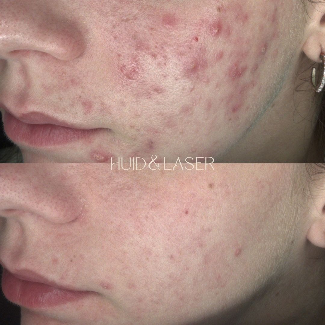 Acne 11