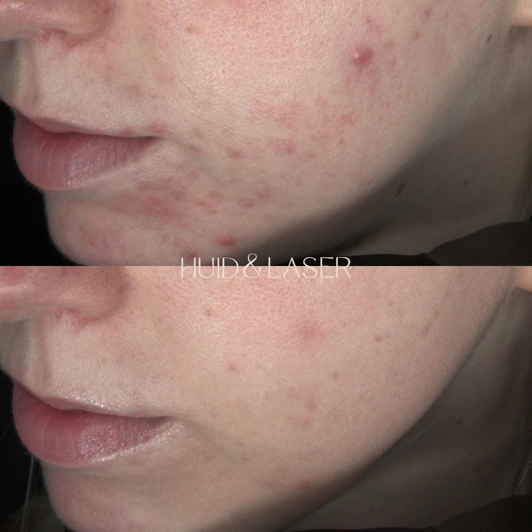 Acne 12