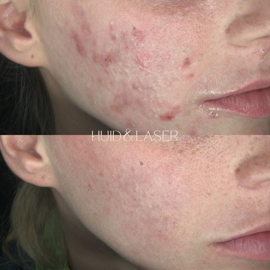 Acne 15